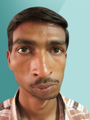 Facial Surgery Thrissur Thrissur