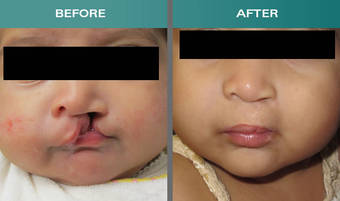 Cleft lip and Palate Treatment