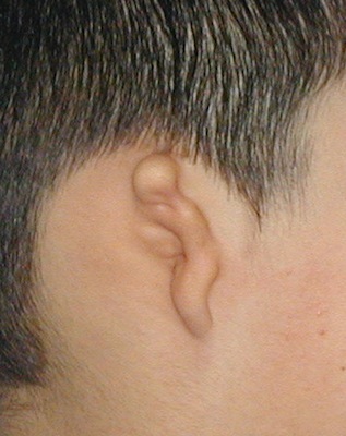 Microtia Ear 