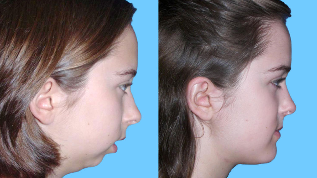 Lower Jaw Surgery