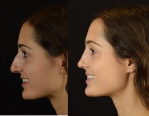 rhinoplasty-before-after-thrissur