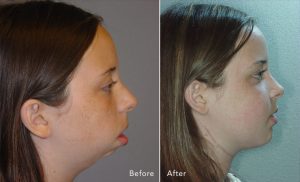 Jaw Correction Surgery