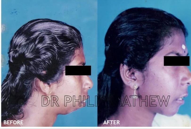 Maxillary Prognathism Treatment