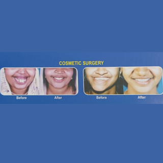 Maxillary Prognathism Treatment