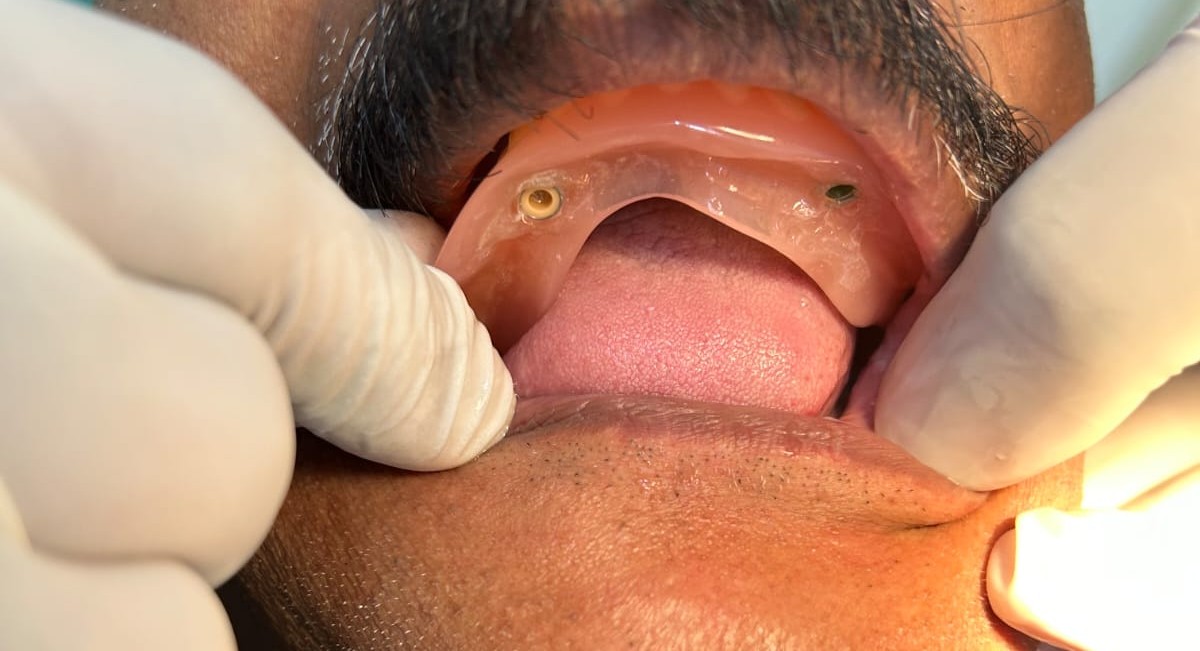 Jaw Correction Surgery