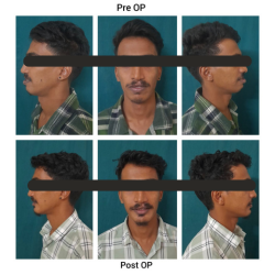 Maxillary Surgery Result