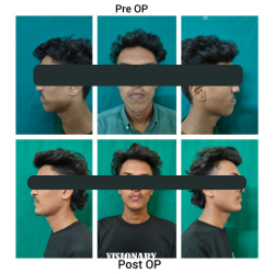 Jaw Correction Surgery