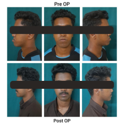 Maxillary Surgery Result