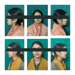 Maxillary Surgery Result