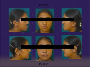 Jaw Correction Surgery