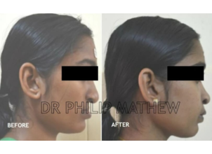Jaw Correction Surgery