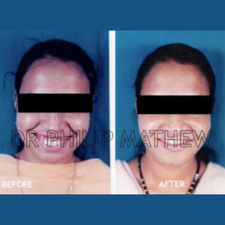 Maxillary Prognathism Treatment