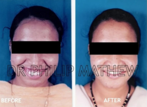 Jaw Correction Surgery