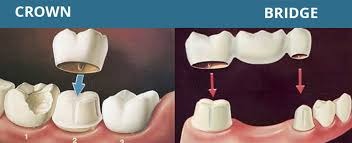 Maxillary Prognathism Treatment