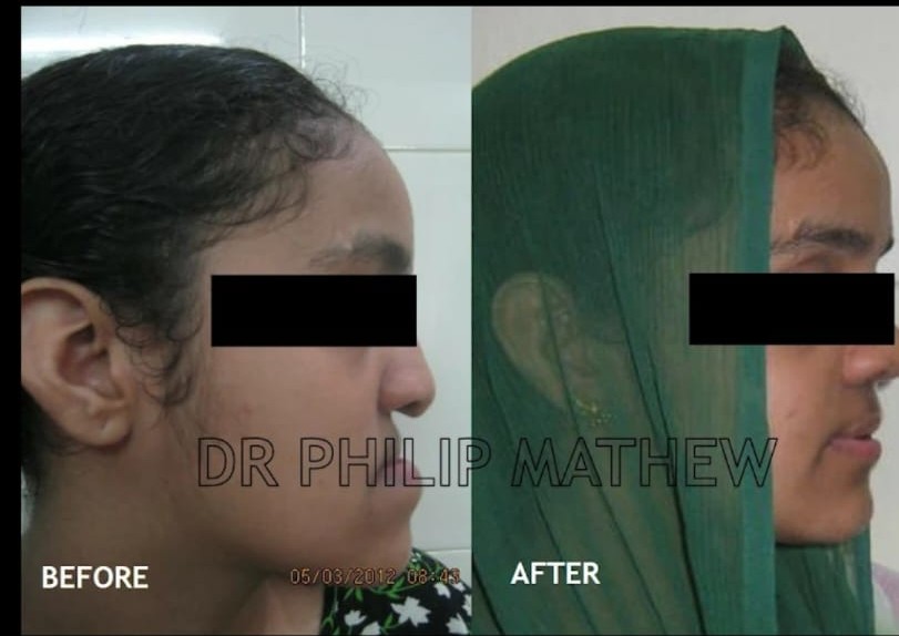 Maxillary Surgery Result