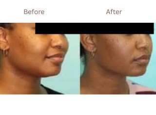 Cheek Contouring