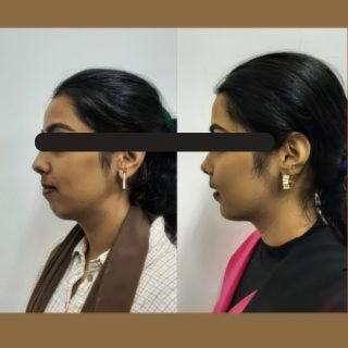 Jaw Contouring / Jaw Repair