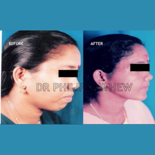 Maxillary Prognathism(Upper Jaw Deformity)