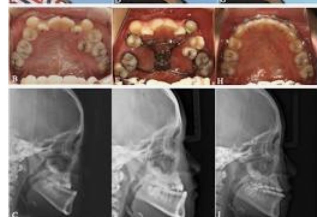 Maxillary Prognathism(Upper Jaw Deformity)