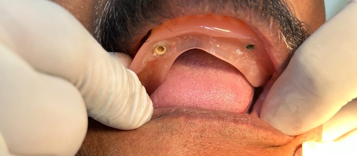 Dental Implants