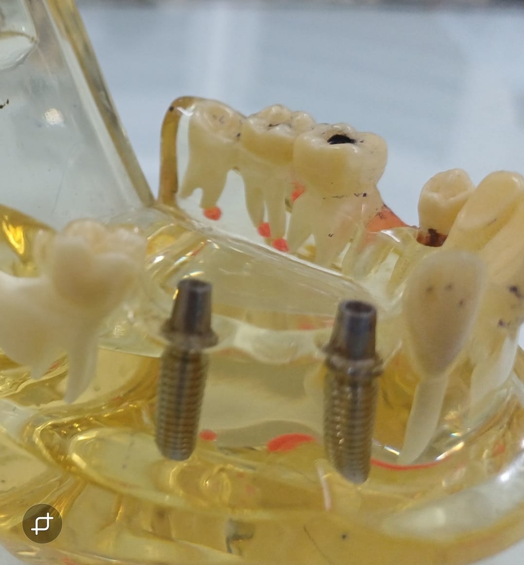 Dental Implants
