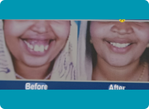 Maxillary Prognathism(Upper Jaw Deformity)