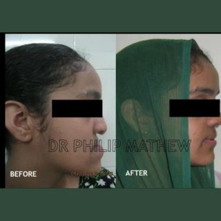 Mandibular Jaw Orthognathic Surgery