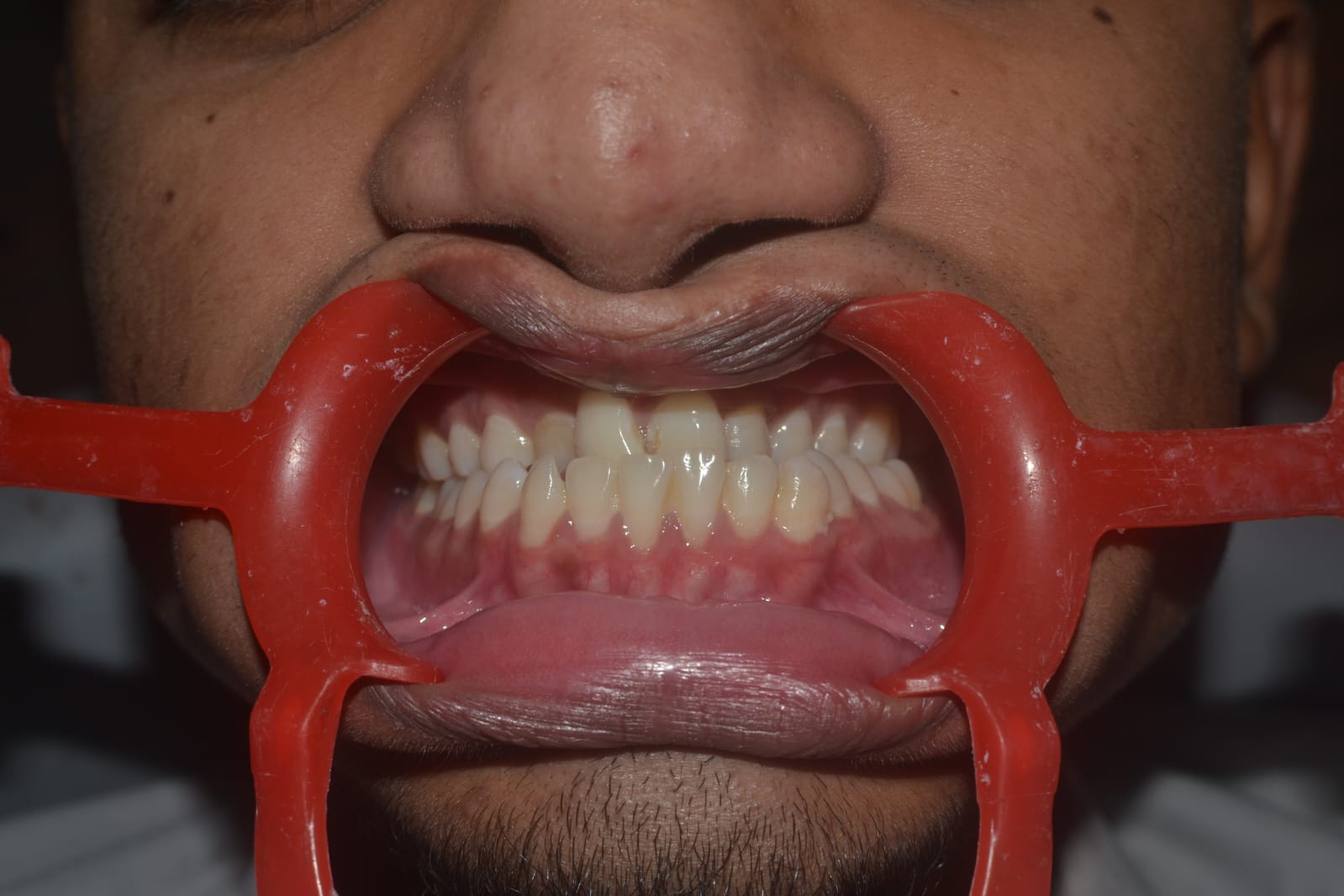 Mandibular Jaw Orthognathic Surgery