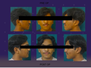 Mandibular Jaw Orthognathic Surgery