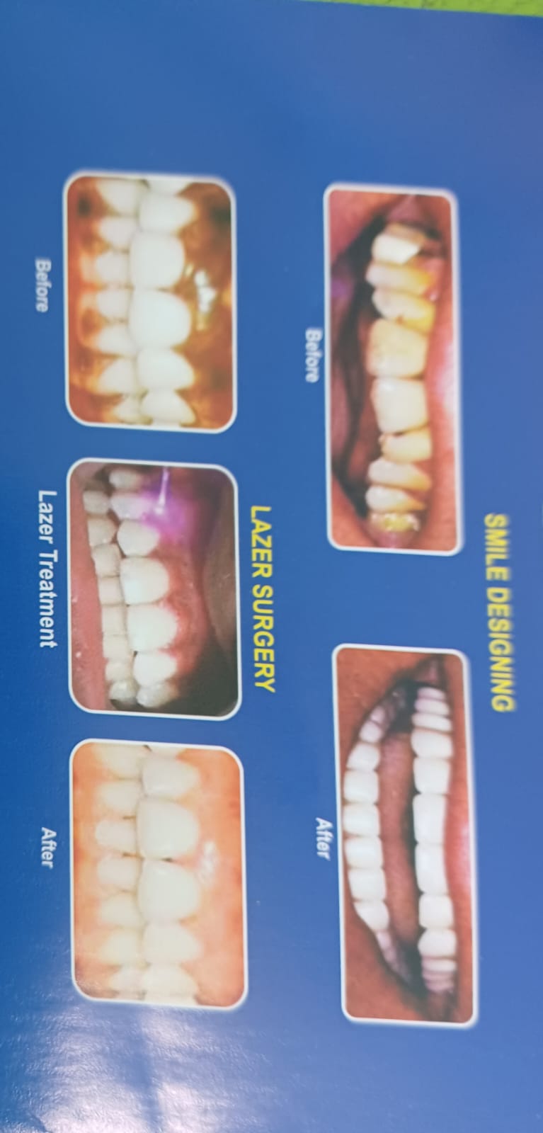 Smile Design