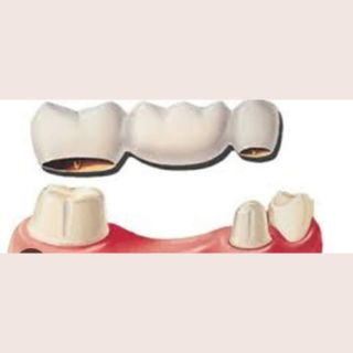 Fixed Denture