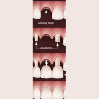 Fixed Denture