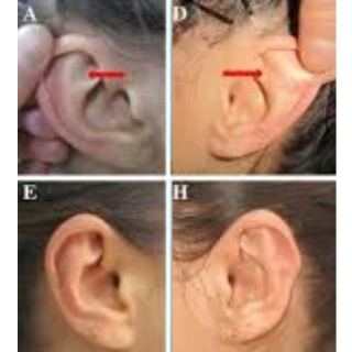 Otoplasty