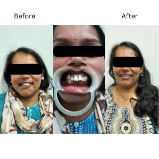 Smile Design