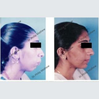 Facial Plastic Surgery