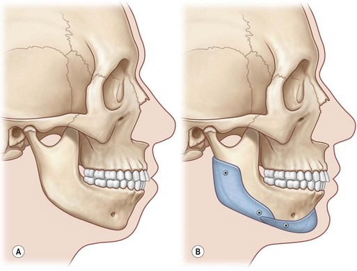 Orthognathic Surgery