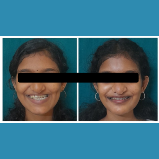 Orthognathic Surgery
