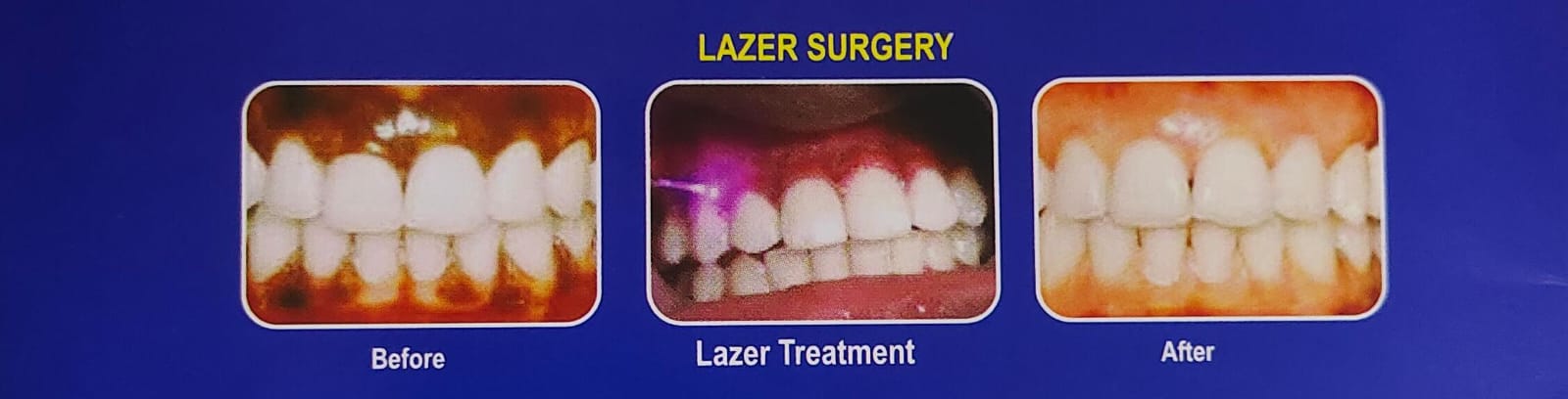 Laser Bleaching