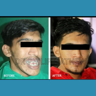 Facial Plastic Surgery