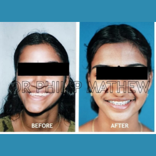 Orthognathic Surgery