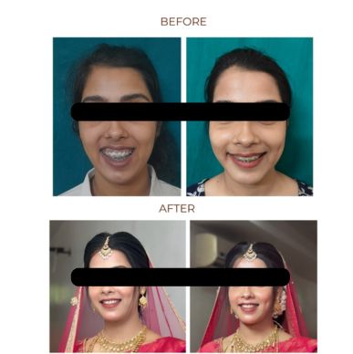 Maxillary Prognathism(Upper Jaw Deformity)