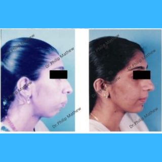 Deficient Chin