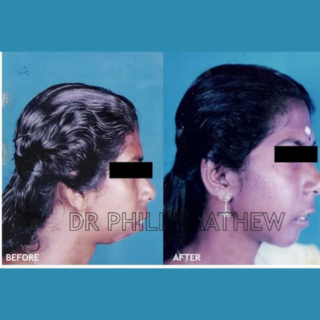 Jaw Contouring / Jaw Repair