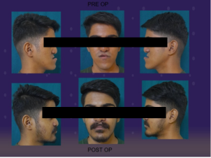 Mandibular Jaw Orthognathic Surgery