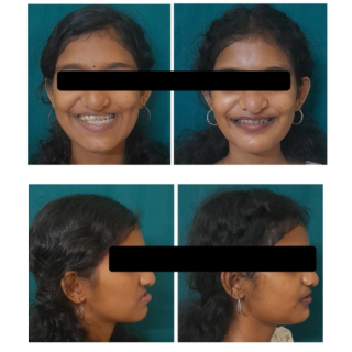 Facial Asymmetry Correction