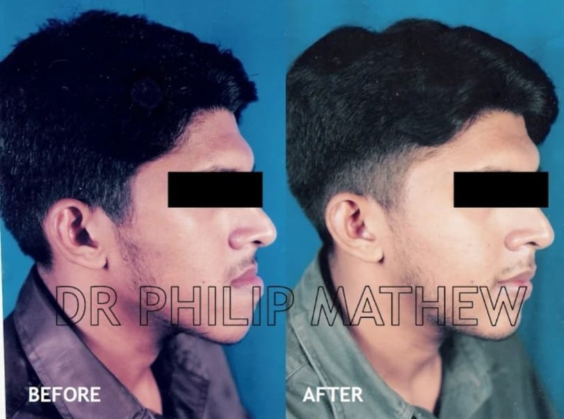 Mandibular Jaw Orthognathic Surgery