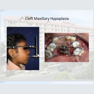 Maxillary Hypoplasia