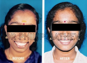 Maxillary Prognathism(Upper Jaw Deformity)