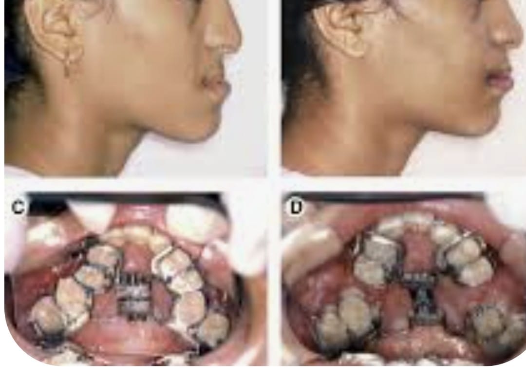 Maxillary Prognathism(Upper Jaw Deformity)