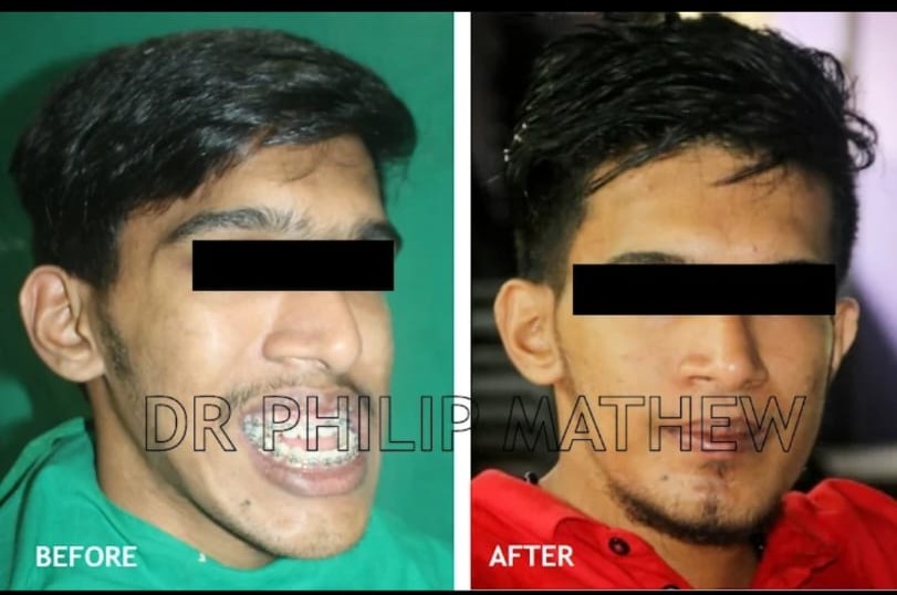 Mandibular Jaw Orthognathic Surgery